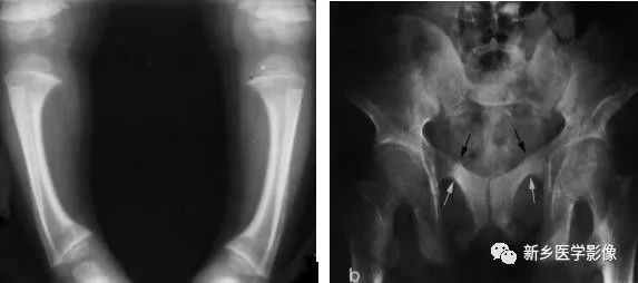 骨骼疾病怎么调理最有效,骨骼坏死最佳治疗方法