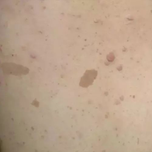 孕妇有咖啡斑会遗传给宝宝吗,孕妇喝咖啡胎儿会长斑吗