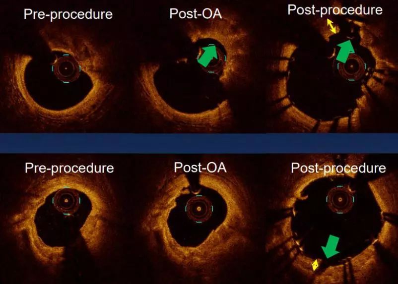 CIT2019｜李妍教授：OCT指导钙化病变，这些精髓要知道