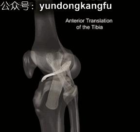 膝内侧副韧带损伤吃什么药,膝韧带损伤预防与康复训练