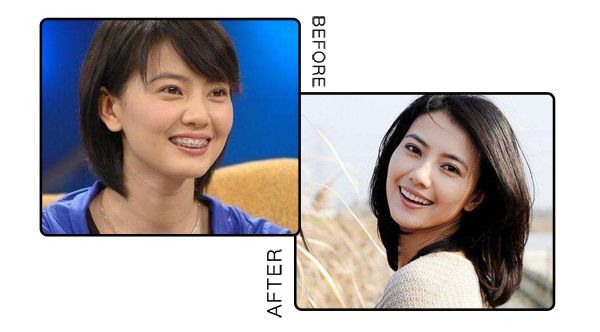 戴牙套换粗钢丝,拔四颗牙戴牙套的脸型变化图