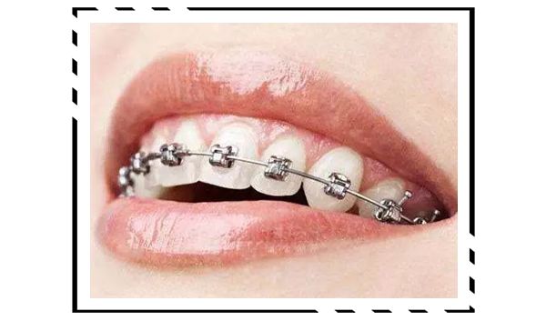 戴牙套整牙的全过程,隐形牙套换头