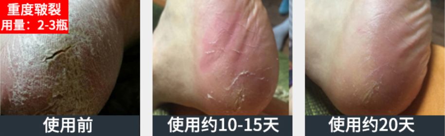 足部护理加长加热脚套,足部护理脚趾套品牌