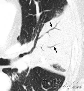 胸部解剖及常见疾病影像表现,胸部影像学基础知识