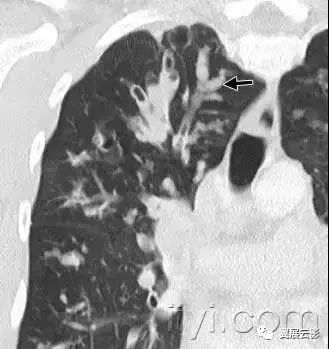 胸部解剖及常见疾病影像表现,胸部影像学基础知识