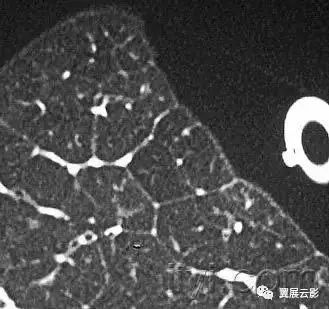 胸部解剖及常见疾病影像表现,胸部影像学基础知识