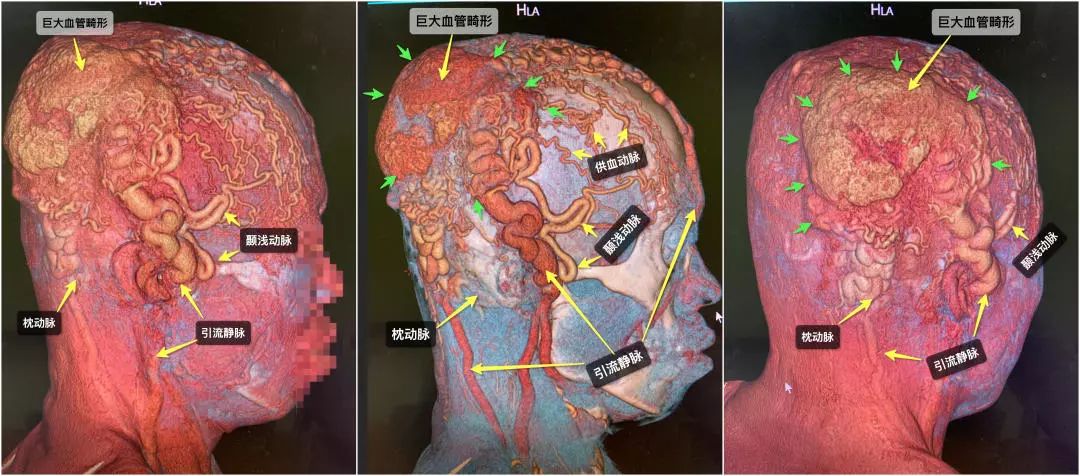 清华长庚血管外科,北京清华长庚医院治疗脑肿瘤好吗