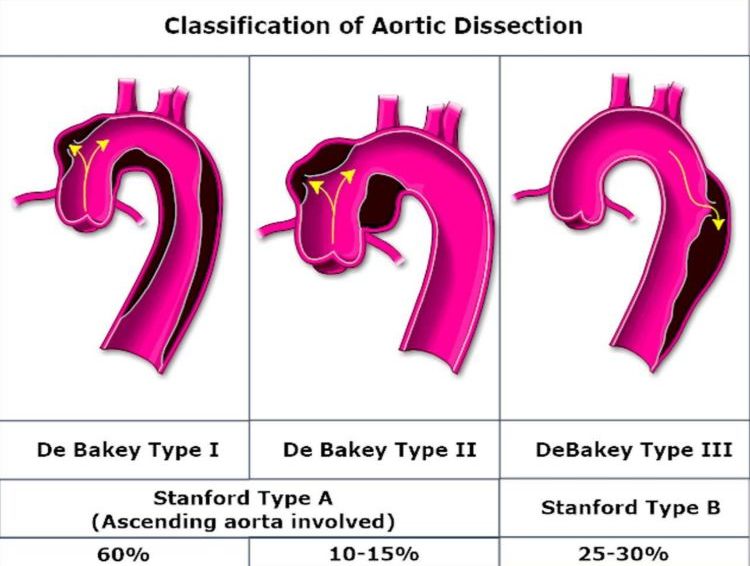华西主动脉夹层手术怎样,再次救治急性主动脉夹层取得成功