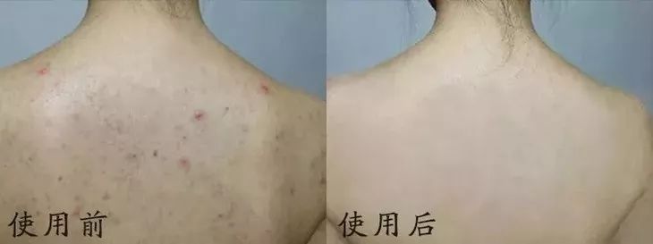 【精选好物】滚一滚，全身缩水小一圈！明星都爱的淋巴按摩仪，滚出小蛮腰、小V脸