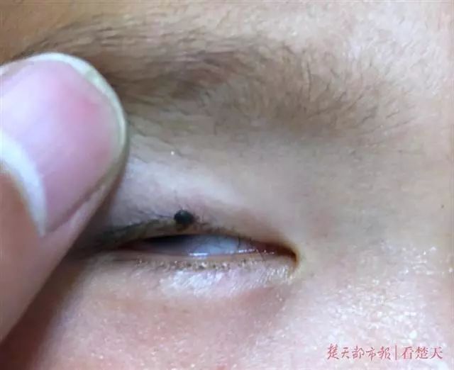 2岁小孩眼睛上突然长了一颗黑痣,2岁小孩眼皮上长了个红疙瘩