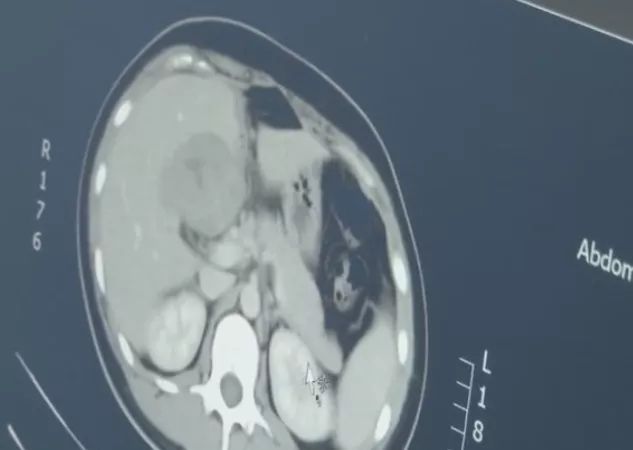 罕见女子2个子宫同时怀孕,罕见孕妇怀上五胞胎