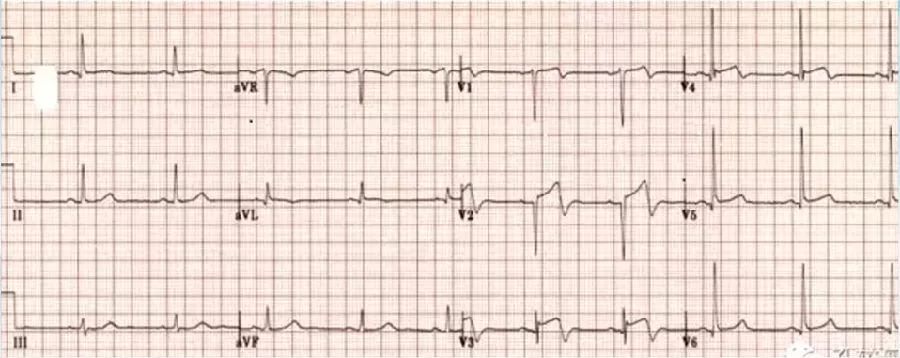 胸痛心电图表现,胸痛的心电图鉴别诊断