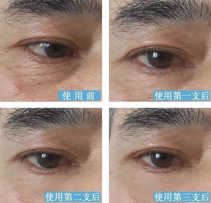 德国变态震动棒，啪啪啪间抚平眼袋、黑眼圈！不用开刀，就能让你年轻十岁！