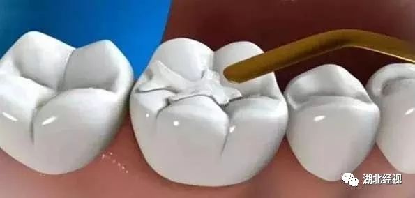 武汉种植牙齿需要多少钱,武汉种植牙齿一颗要多少钱