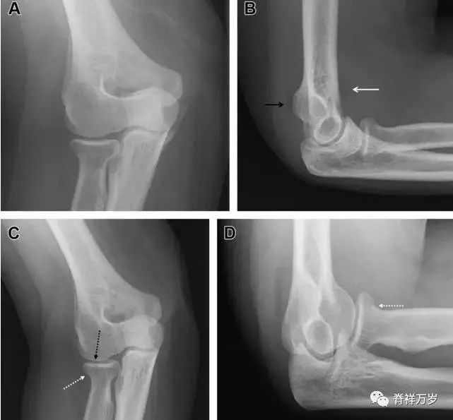肩关节脱位易漏诊的骨折,放射科容易漏诊的骨折