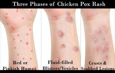 大人起水痘能死人吗,水痘造成多少人死亡