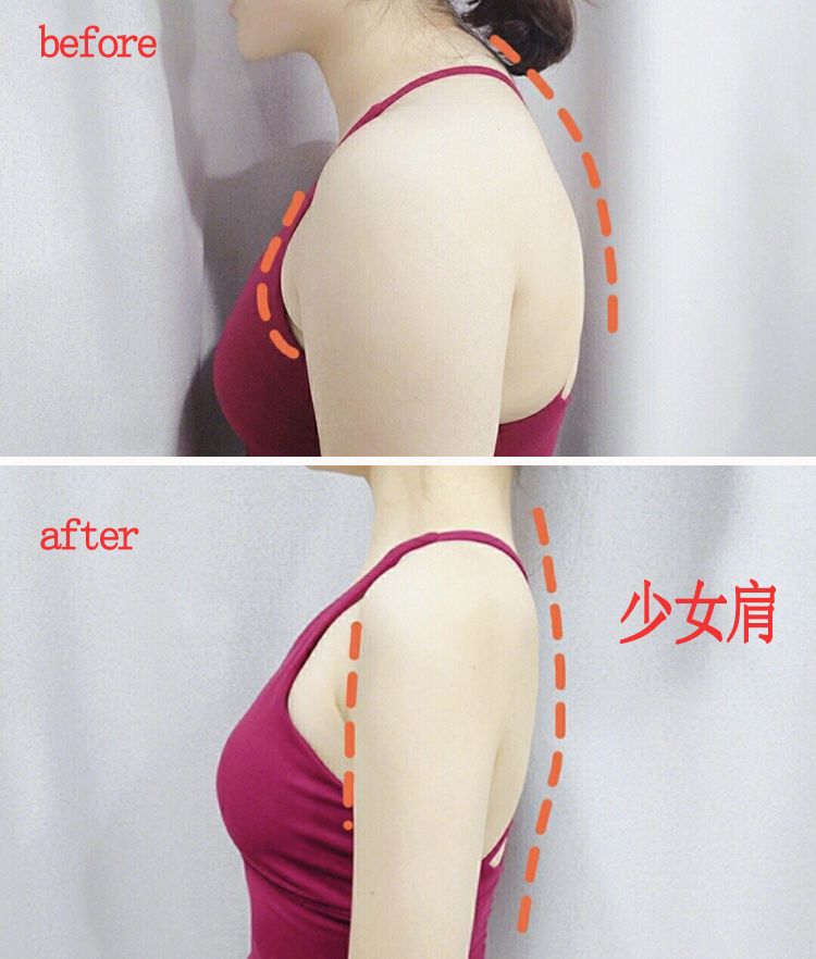 有什么方法可以改善含胸驼背,含胸驼背改善的方法