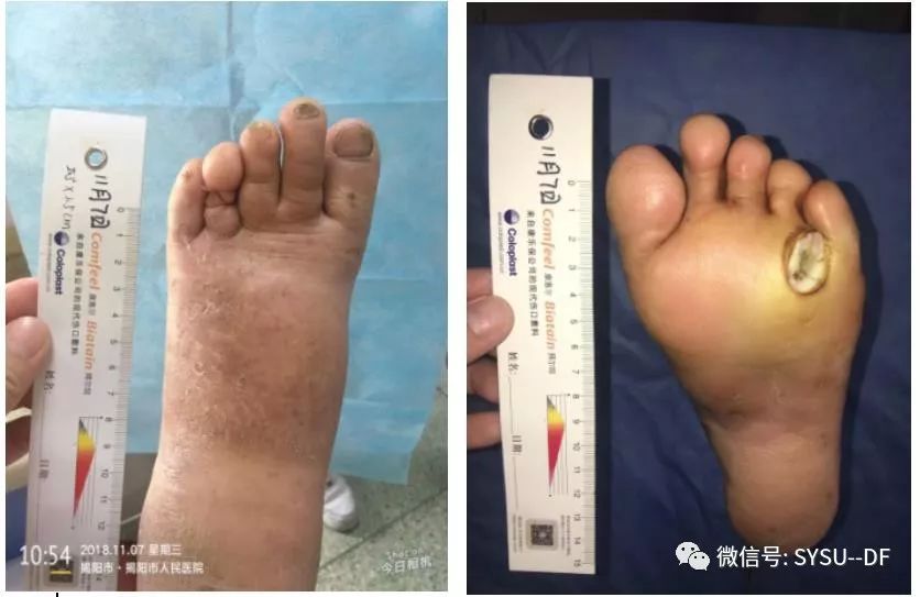 负压吸引糖尿病足的应用,负压滴灌治疗糖尿病足优势是什么