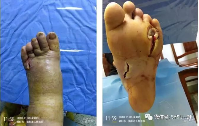 负压吸引糖尿病足的应用,负压滴灌治疗糖尿病足优势是什么