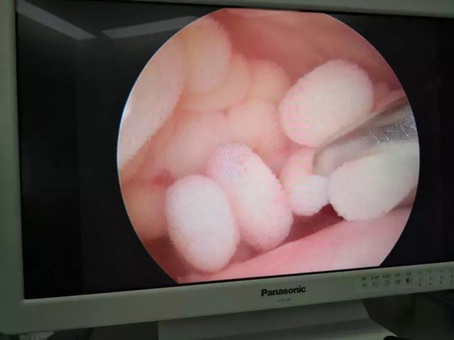 男子肩膀发现豌豆大结节,左肩上方一块肿大是怎么回事