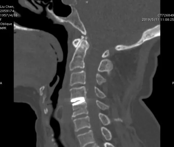 全球首例3D打印人体颈椎术，西安做到了！