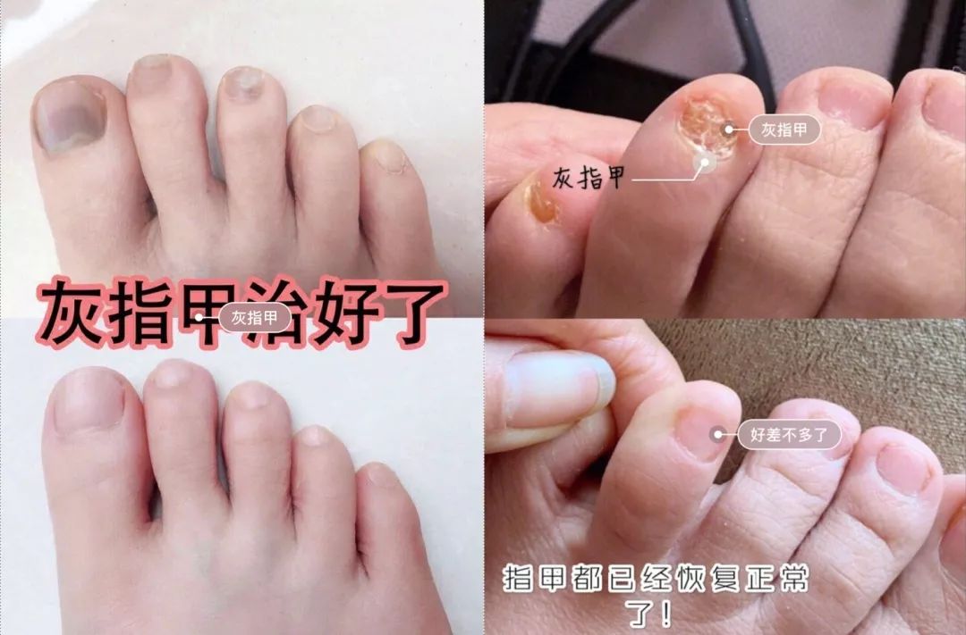 十年脚气怎么治才能除根,十年顽固脚气