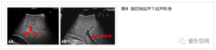 吲哚菁绿荧光引导腹腔镜解剖性肝脏Ⅶ段切除手术流程