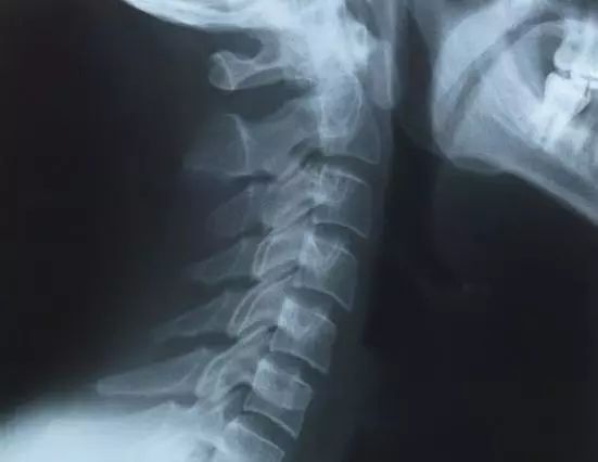 颈椎骨质增生看病经验分享,颈椎康复科普类短视频