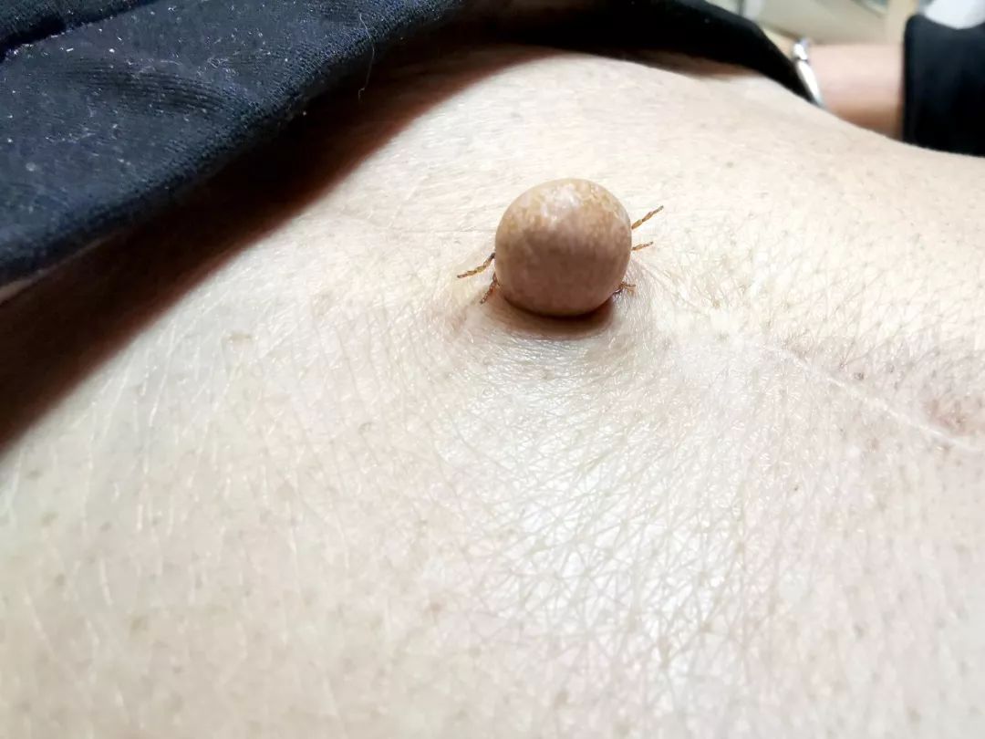 成人肚脐眼凸起肉球严重吗,成人肚脐眼凸起肉球治疗全过程