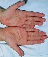 手足口病疫苗是预防终身吗,ev71手足口病疫苗潮州哪里有得打