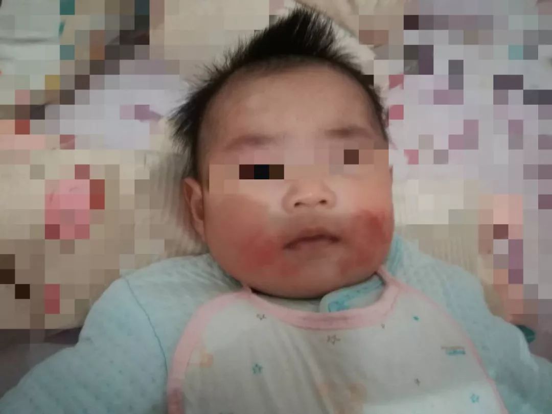 医生说湿疹不一定是坏事为什么,孩子湿疹不好一直用激素药膏