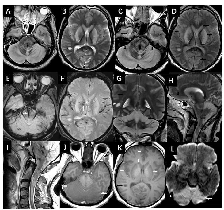 异丙醇中毒怎么治疗,洗手液误食有什么危害