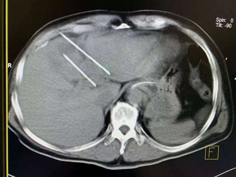 肝癌合并门静脉癌栓怎么办,纳米刀成对付癌中王的新利器