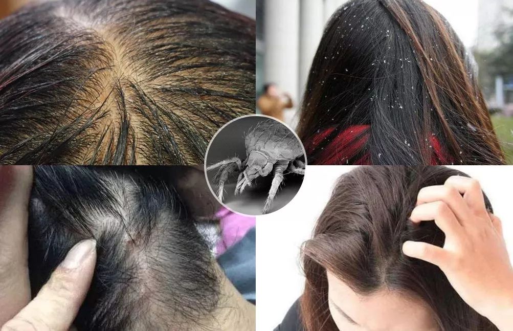 头皮除螨虫神器哪种好用,头屑头油清除神器第一名