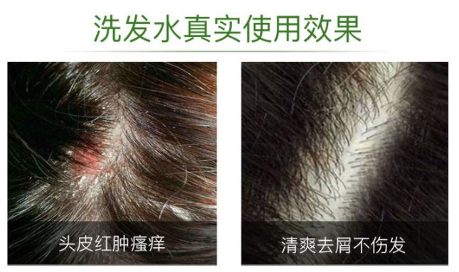 头皮除螨虫神器哪种好用,除头螨头屑小窍门