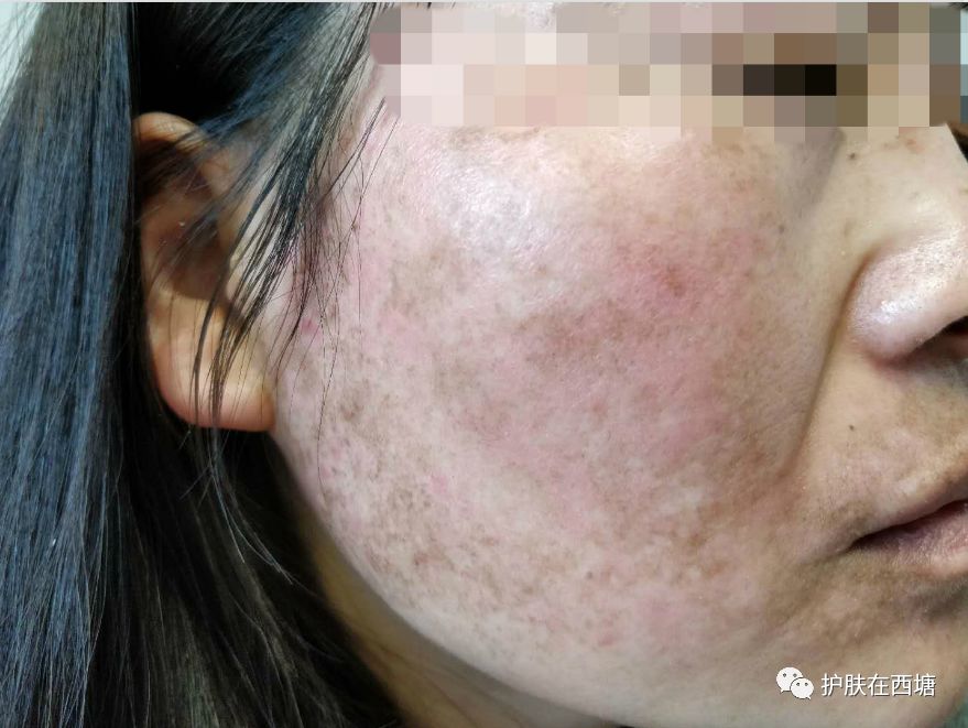 面部敏感性皮炎科普知识,激素依赖性皮炎是什么皮肤病
