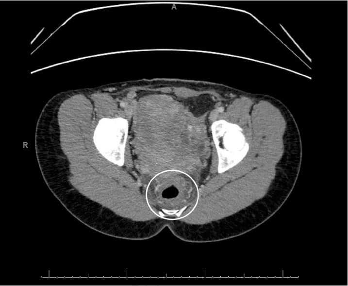 病例分享|一键保存!年轻女性因直肠疼痛而无法坐下?