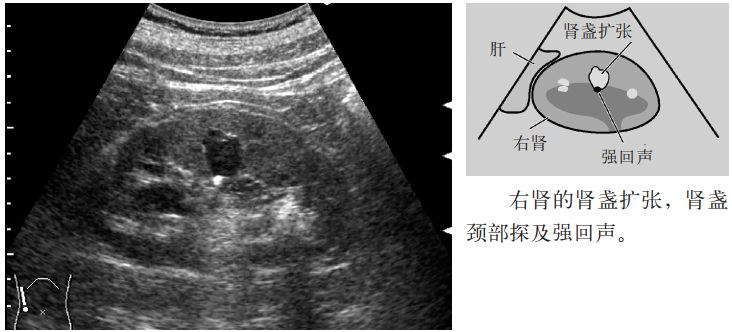 肾盏憩室和肾囊肿b超表现,肾盏憩室误诊肾囊肿案例
