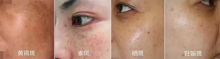 如何改善色斑暗沉问题,面色暗沉色斑多如何改善