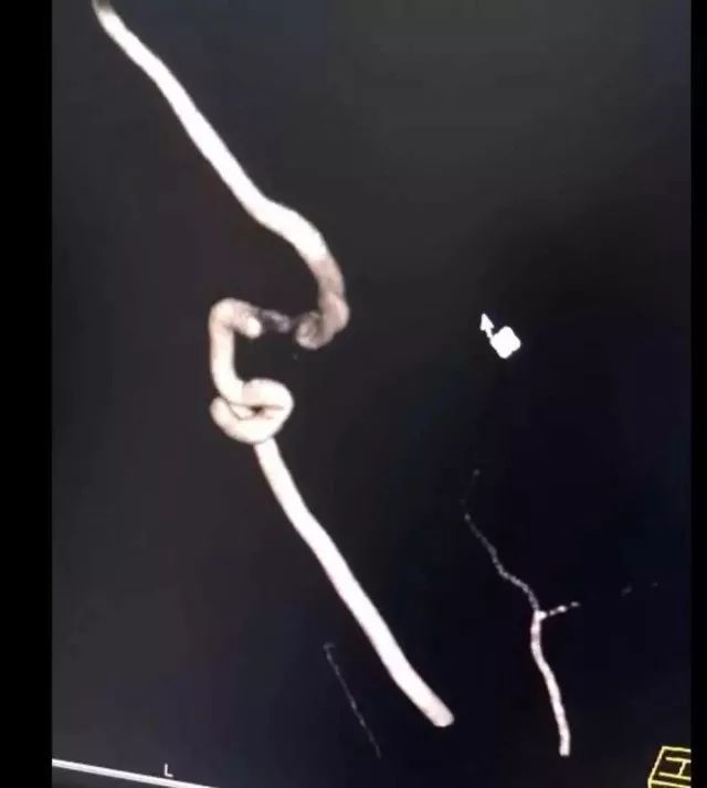 危险27岁女子突发脑梗,一女子突发脑梗