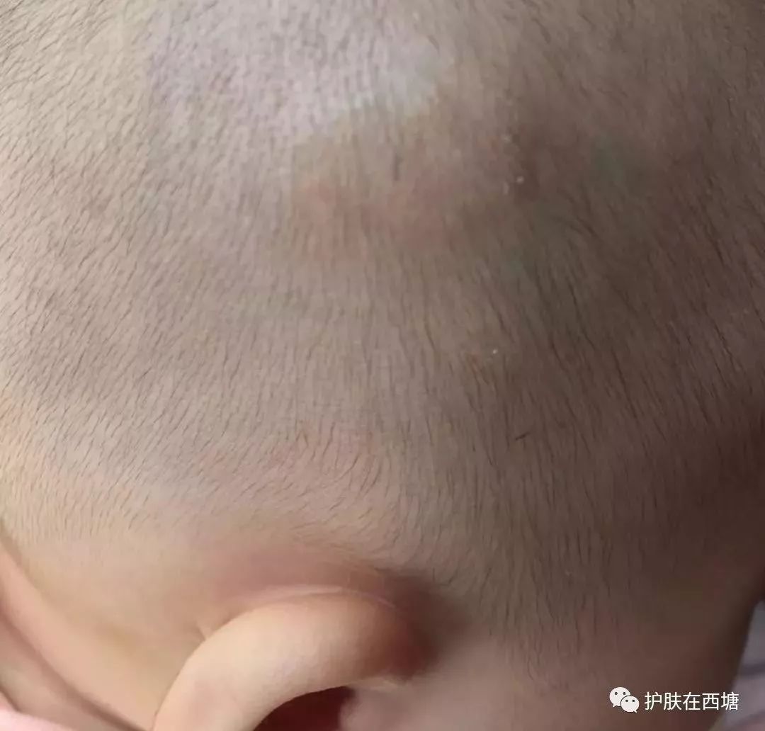 常见面部皮肤病,三脂溢性皮炎