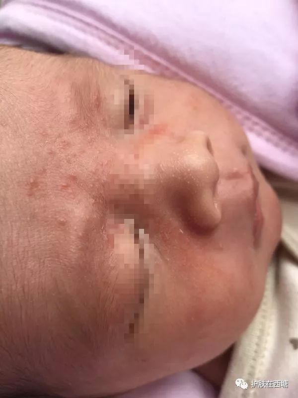 常见面部皮肤病,三脂溢性皮炎