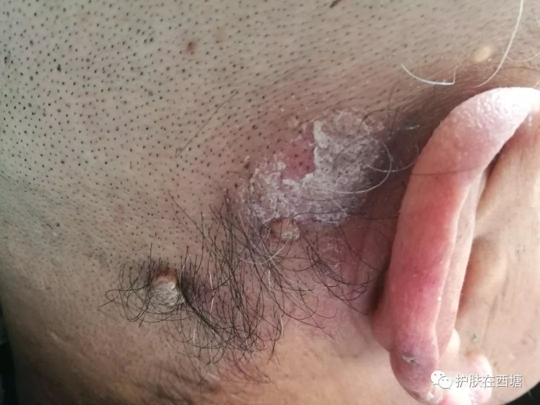 他克莫司软膏治疗脂溢性皮炎,面部皮肤脂溢性皮炎治疗方法