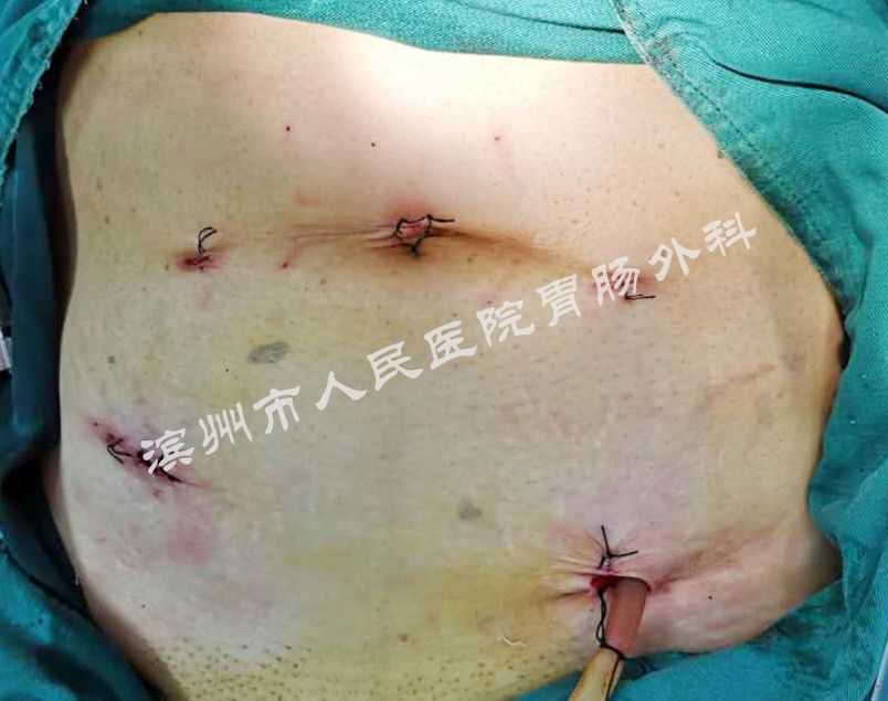 结直肠恶性肿瘤腹腔镜手术,结直肠肿瘤的外科微创治疗