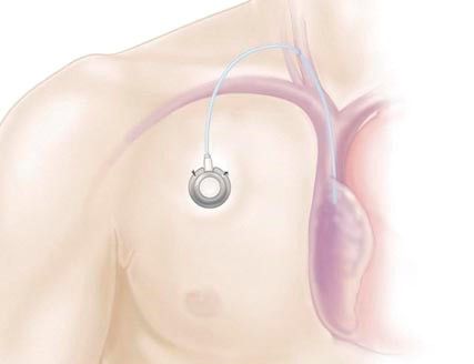 如何给输液港输液,输液港输液还是疼啊