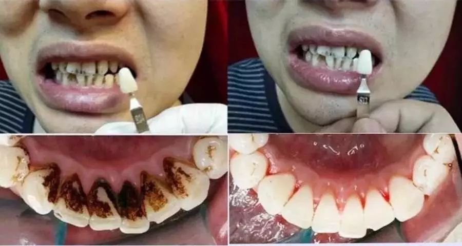 团购|俄罗斯亮白牙膏组合，轻松瓦解多年牙垢，清新口气告别黄牙