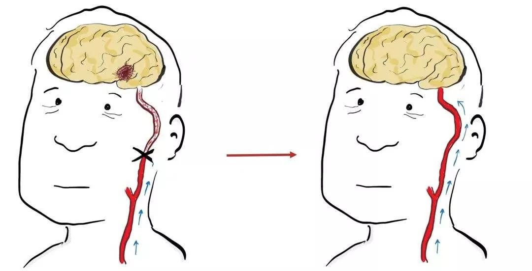 动脉硬化最新检查手段,动脉硬化最佳检查方法