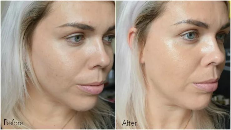 皮肤粗糙暗沉毛孔粗要做什么医美,真正改变毛孔的医美