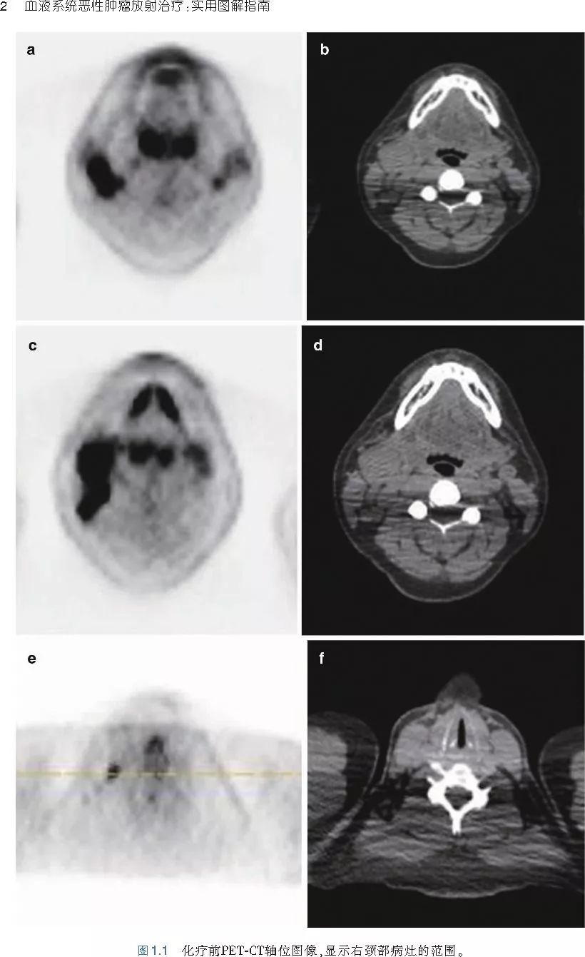 图解血液系统恶性肿瘤放射治疗，如此清晰的指南你见到过吗？