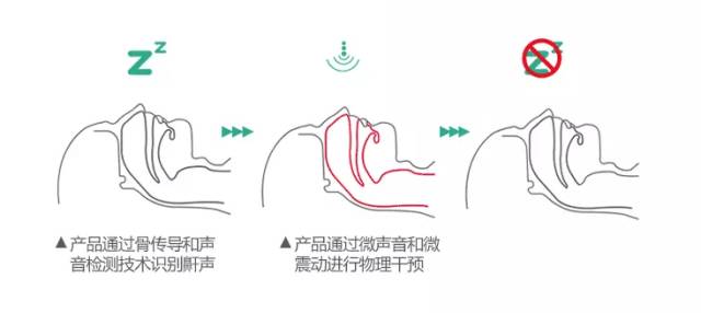 智能止鼾神器防止打呼噜超声波,智能止鼾器治疗打鼾